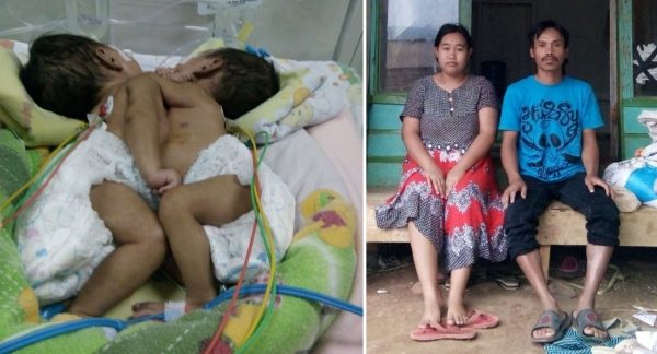 Bayi kembar siam dempet perut, Candra Supriatna dan Candra Supriyadi, (kiri) dan orangtuanya Wasmini dan Lili, warga, Kp. Pasirkunci RT 01 RW 08 Desa Cipanjalu Kec.Cilengkrang Kab.Bandung